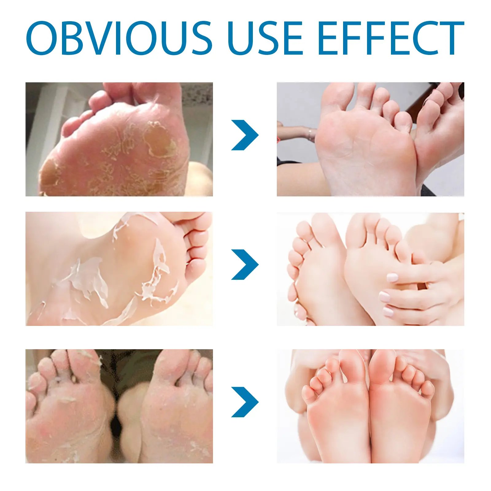 Exfoliating Foot Pads for Callus Removal & Moisturizing 3D Mask - West&Month 7 3d foot pad exfoliate clean anti chap moisturize West Month 373 5876
