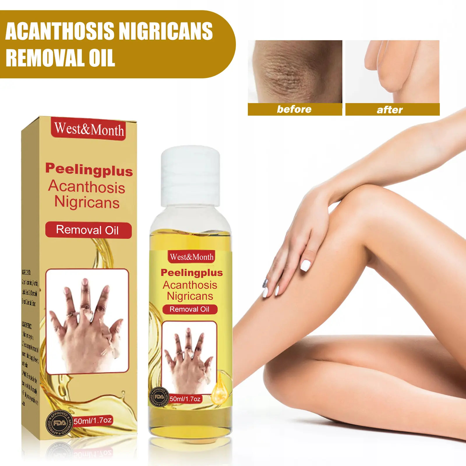 Acanthosis Nigricans Treatment Oil - Exfoliating & Brightening - West&Month 2 acanthosis nigricans removal oil exfoliating West Month 069 1960
