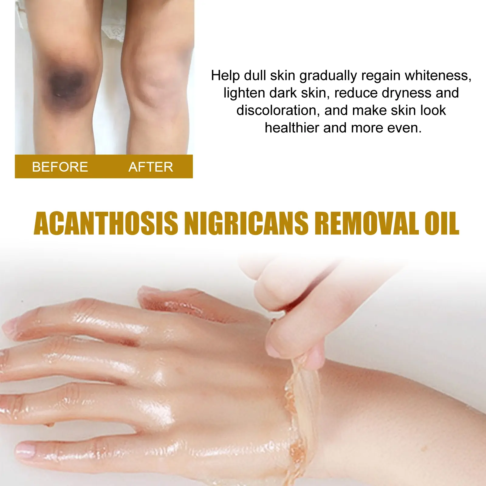 Acanthosis Nigricans Treatment Oil - Exfoliating & Brightening - West&Month 5 acanthosis nigricans removal oil exfoliating West Month 069 1963