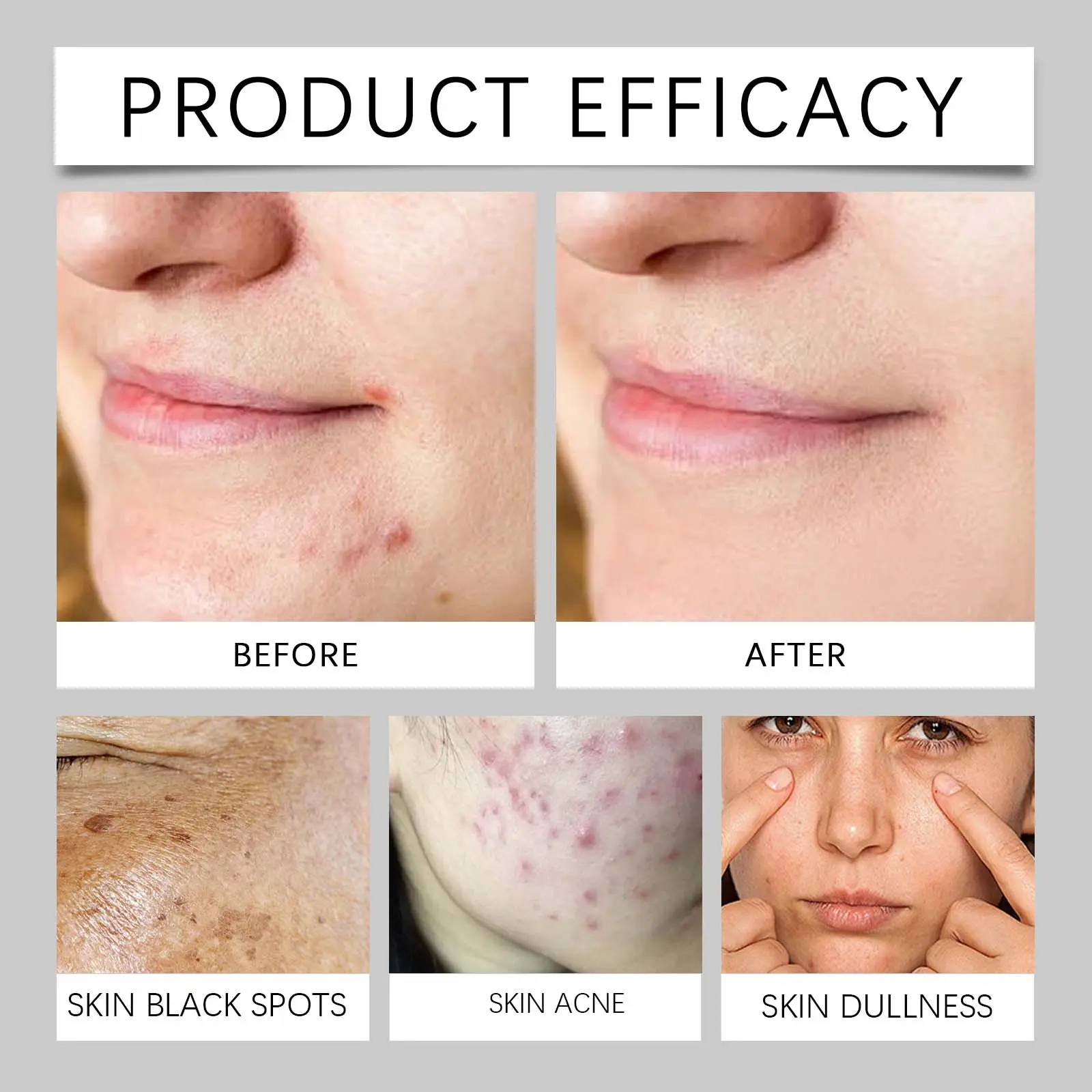 Acne Face Cream with Oil Control & Soothing Formula - West&Month 9 acne cream refresh oil control repair soothe West Month 471 7236