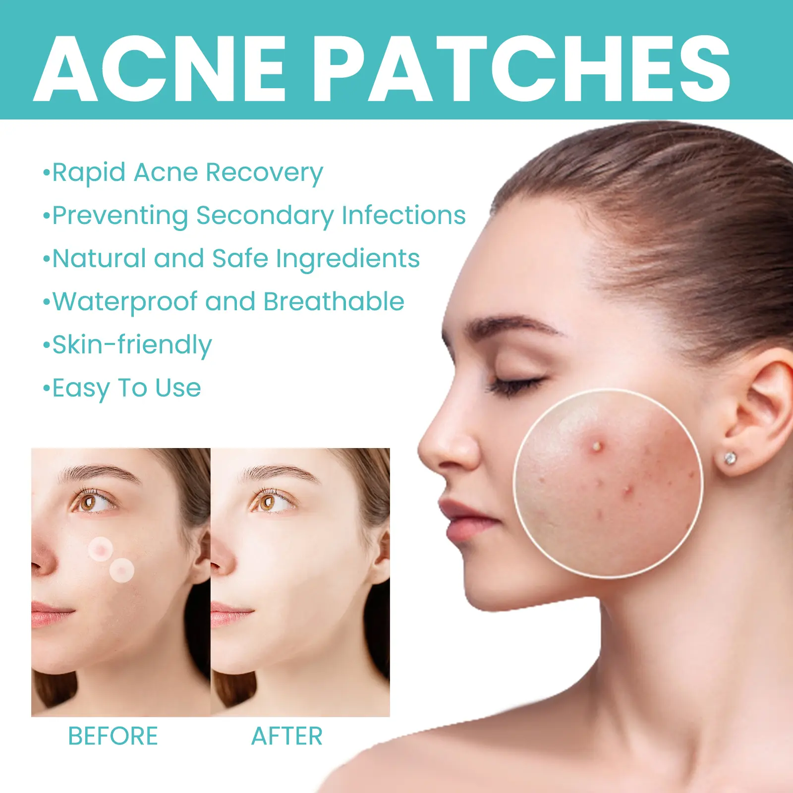 Acne Patches for Blackheads (240 Count) Discreet & Waterproof - West&Month 8 acne patch 300pcs repair invisible breathable West Month 647 9372