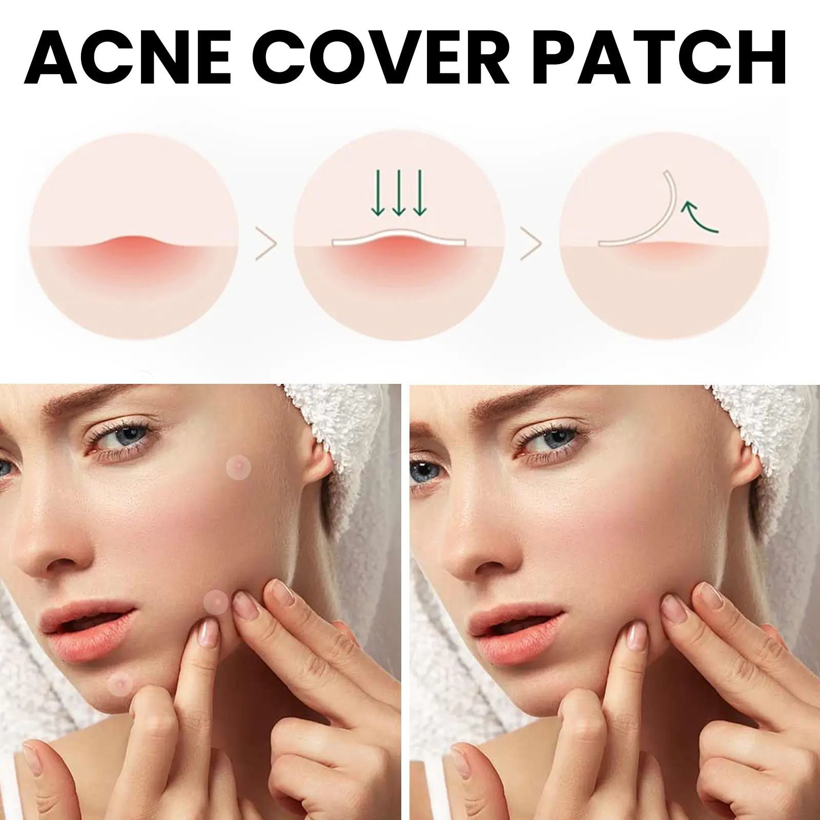 Acne Patches for Closed Comedones Breathable Skin Smoothing Treatment West 7 acne patch repair closed mouth breathable West Month 168 3216