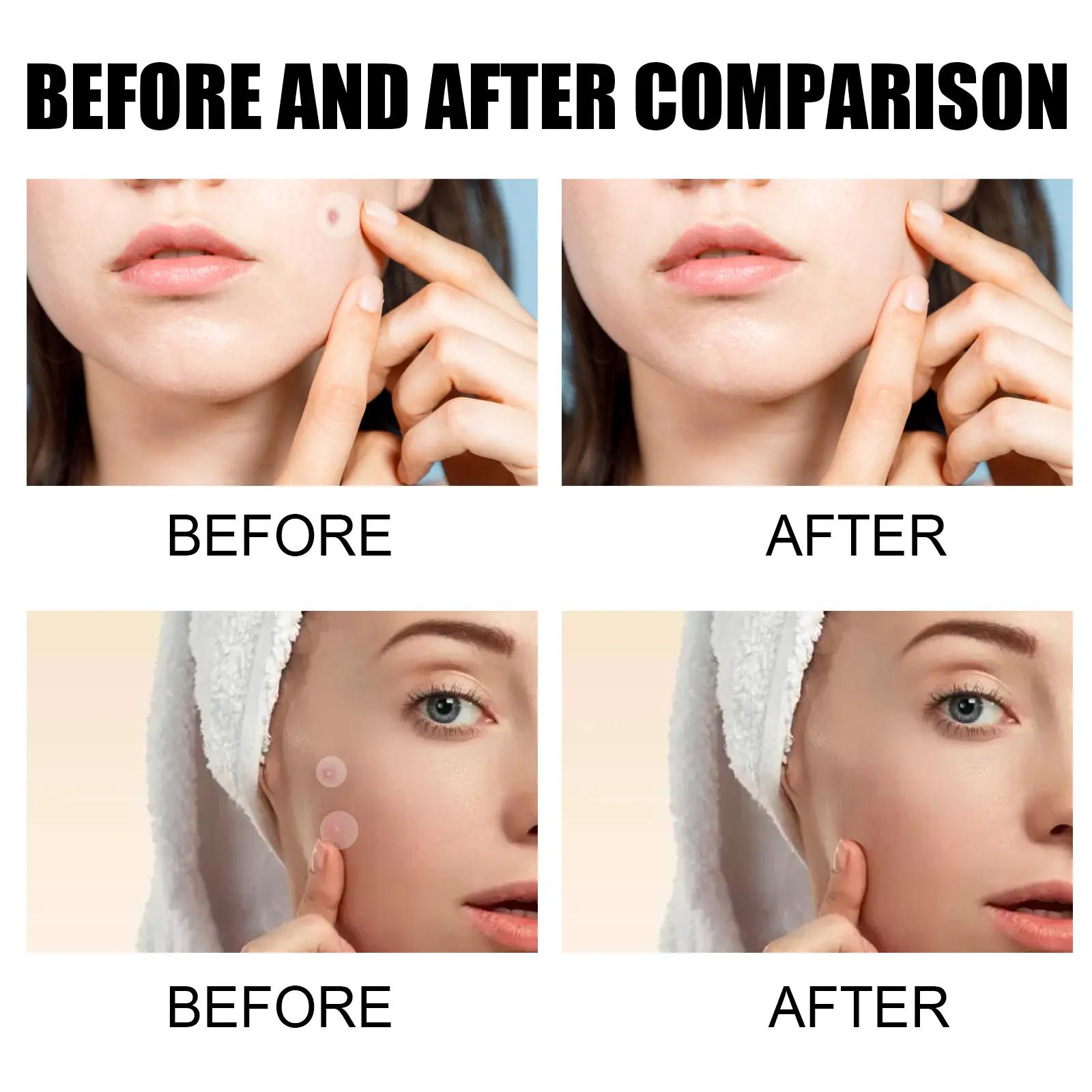 Acne Patches for Closed Comedones Breathable Skin Smoothing Treatment West 10 acne patch repair closed mouth breathable West Month 168 3219