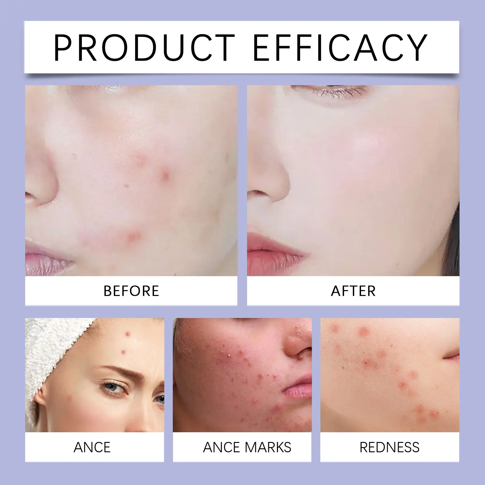 Color Cover Acne Patches for Facial Skin Care - West&Month 9 color cover acne patch mild cover West Month 164 3166