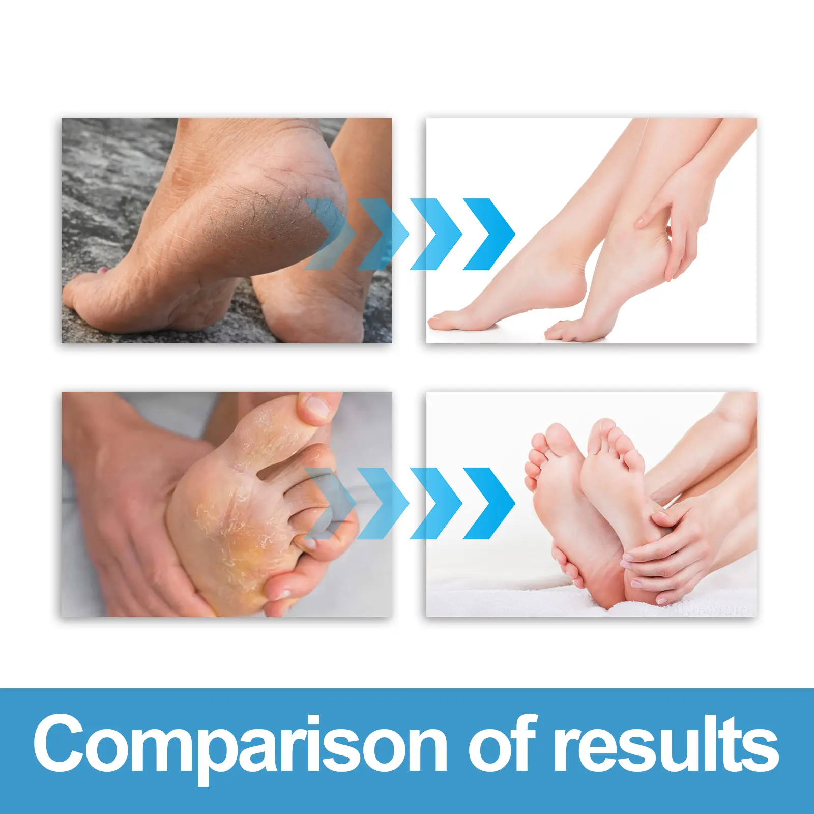 Foot Care Cream for Calluses and Cracked Heels - West&Month 9 foot care cream repair calluses moisturize heel West Month 602 8877