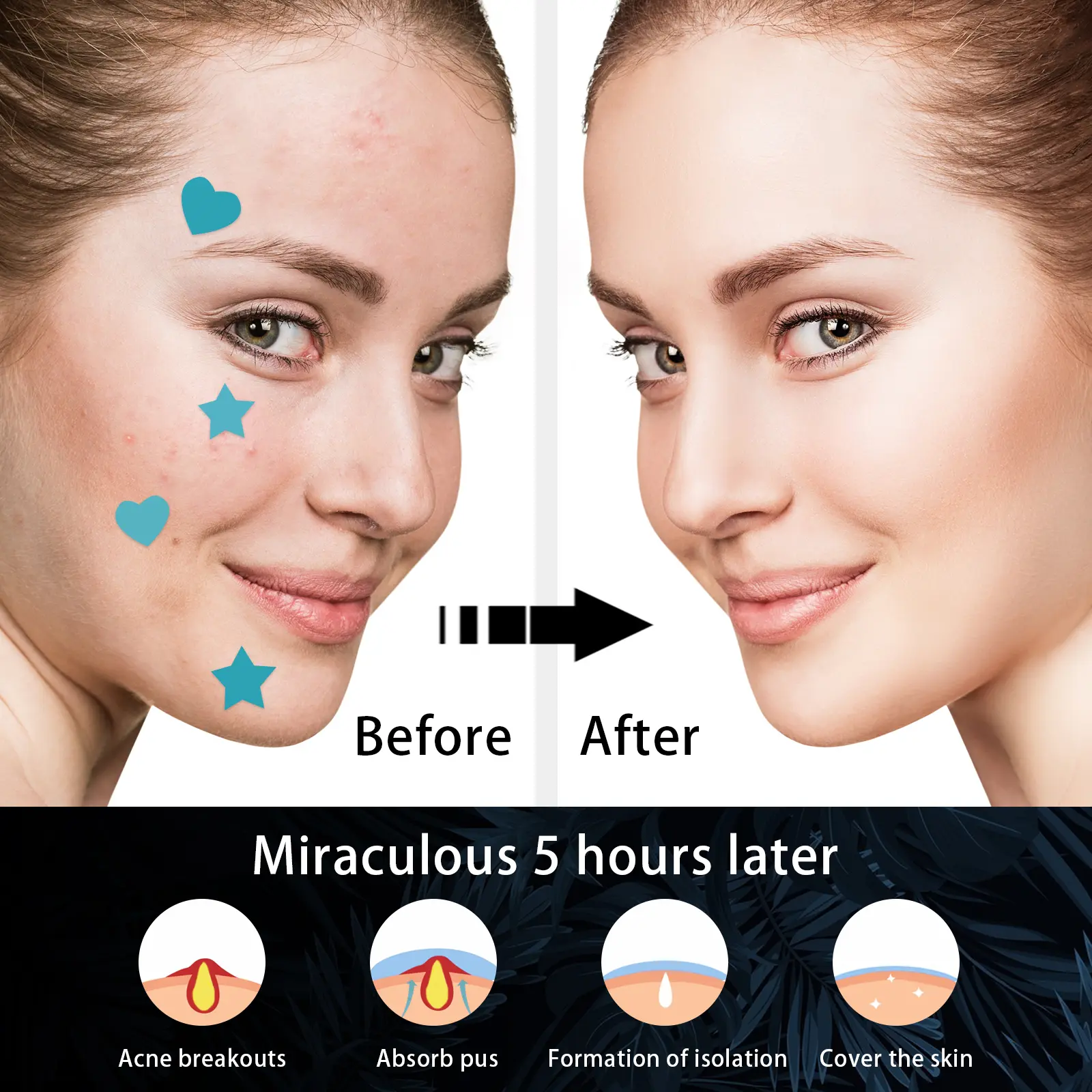 Hydrocolloid Acne Patches - Invisible Waterproof Spot Treatment - West&Month 9 hydrocolloidal acne patch repair acne West Month 020 1362