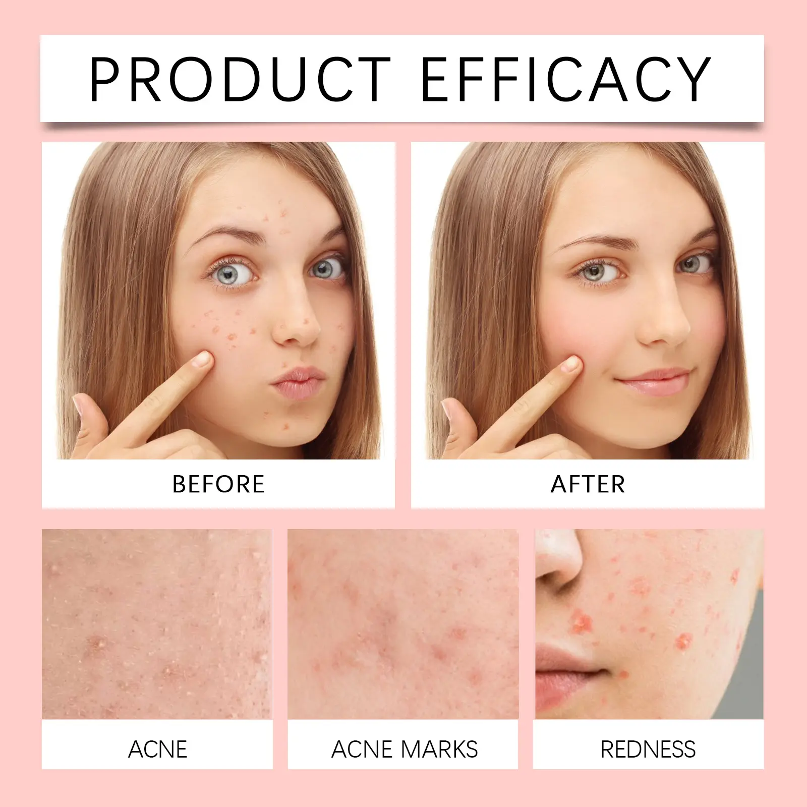 Invisible Acne Patches with Salicylic Acid & Snow Root - West&Month 9 invisible acne patch gentle clean moisturize portable West Month 481 7382