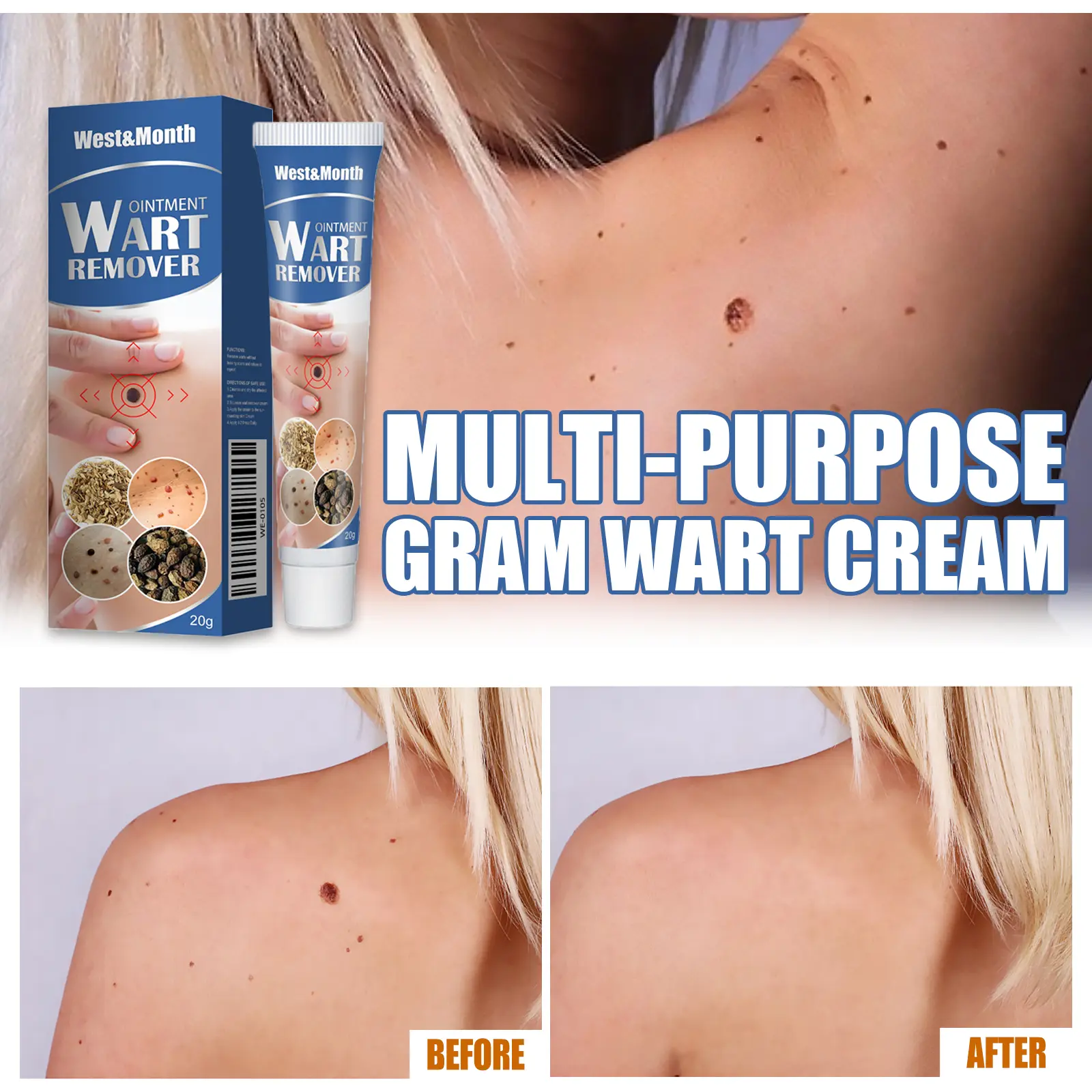 Wart Removal Cream for Clear Skin - West&Month Keu 7 keu cream gently clean hands feet face daily West Month 652 9430