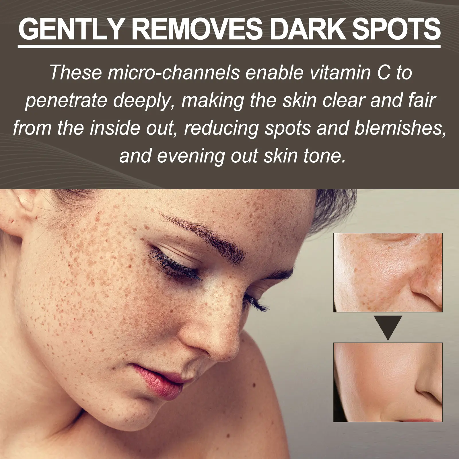 Vitamin C Microneedle Patch for Dark Spots & Acne | West&Month 5 micro needle vita c spot eraser patch West Month 038 1587
