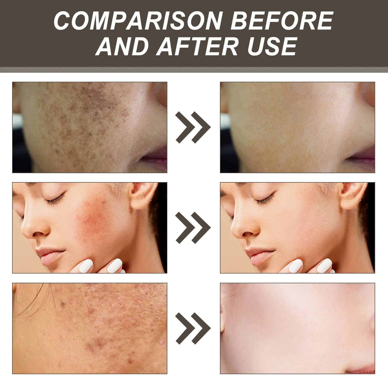 Vitamin C Microneedle Patch for Dark Spots & Acne | West&Month 9 micro needle vita c spot eraser patch West Month 038 1591