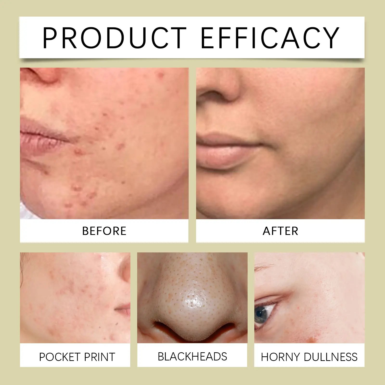 Moisturizing Toner for Acne-Prone Skin - Hydrating & Soothing - West&Month 9 moisturizing toner gently clean acne hydrate West Month 455 7010