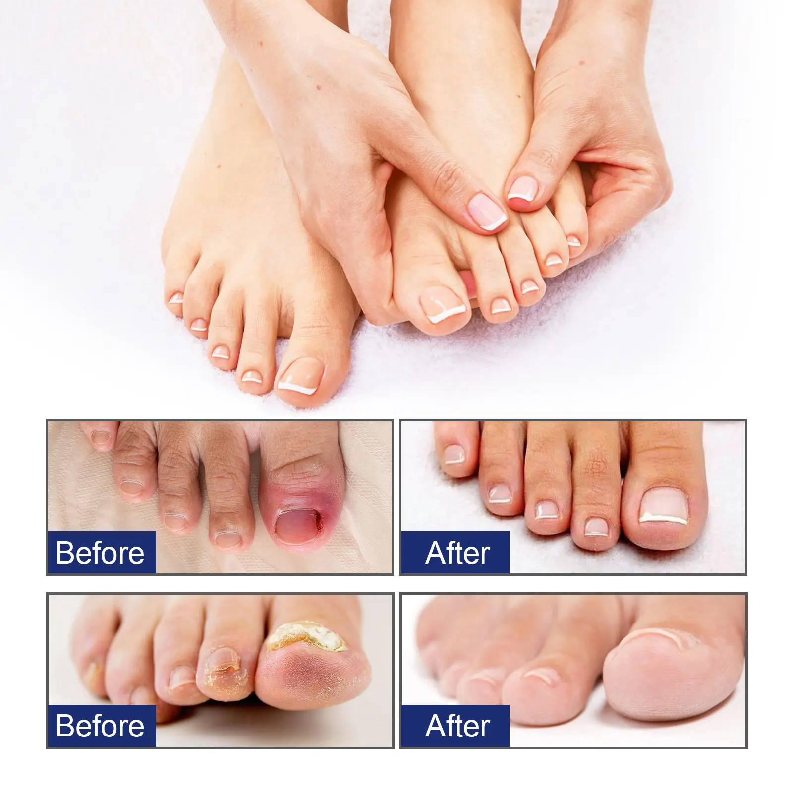 Nail Care Solution for Ingrown Nail Repair and Strength - West&Month 8 nail care solution clean moisturize strong West Month 177 3329
