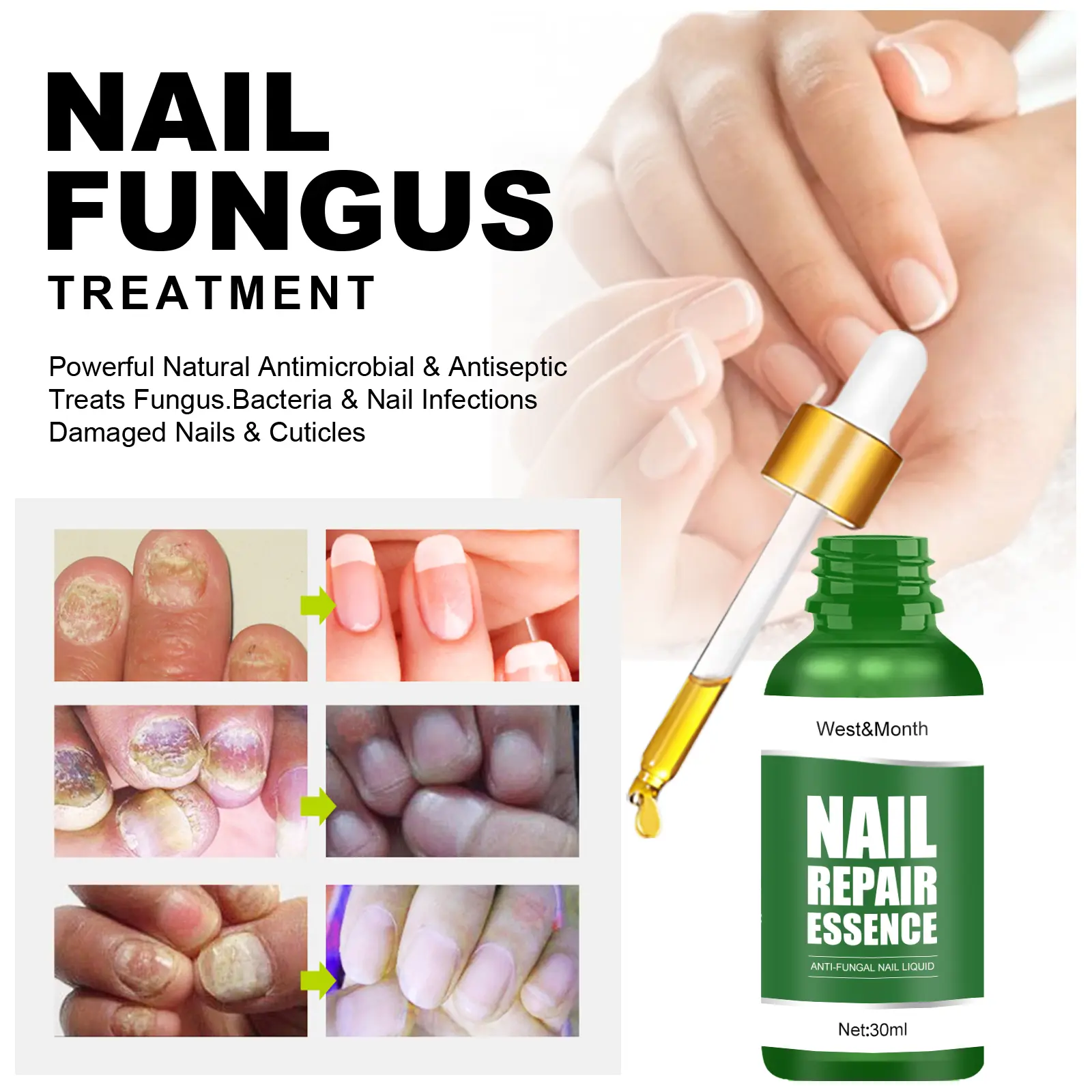 Nail Fungus Treatment Essence for Repair and Recovery - West&Month 4 nail repair essence repair rotten nails West Month 286 4714