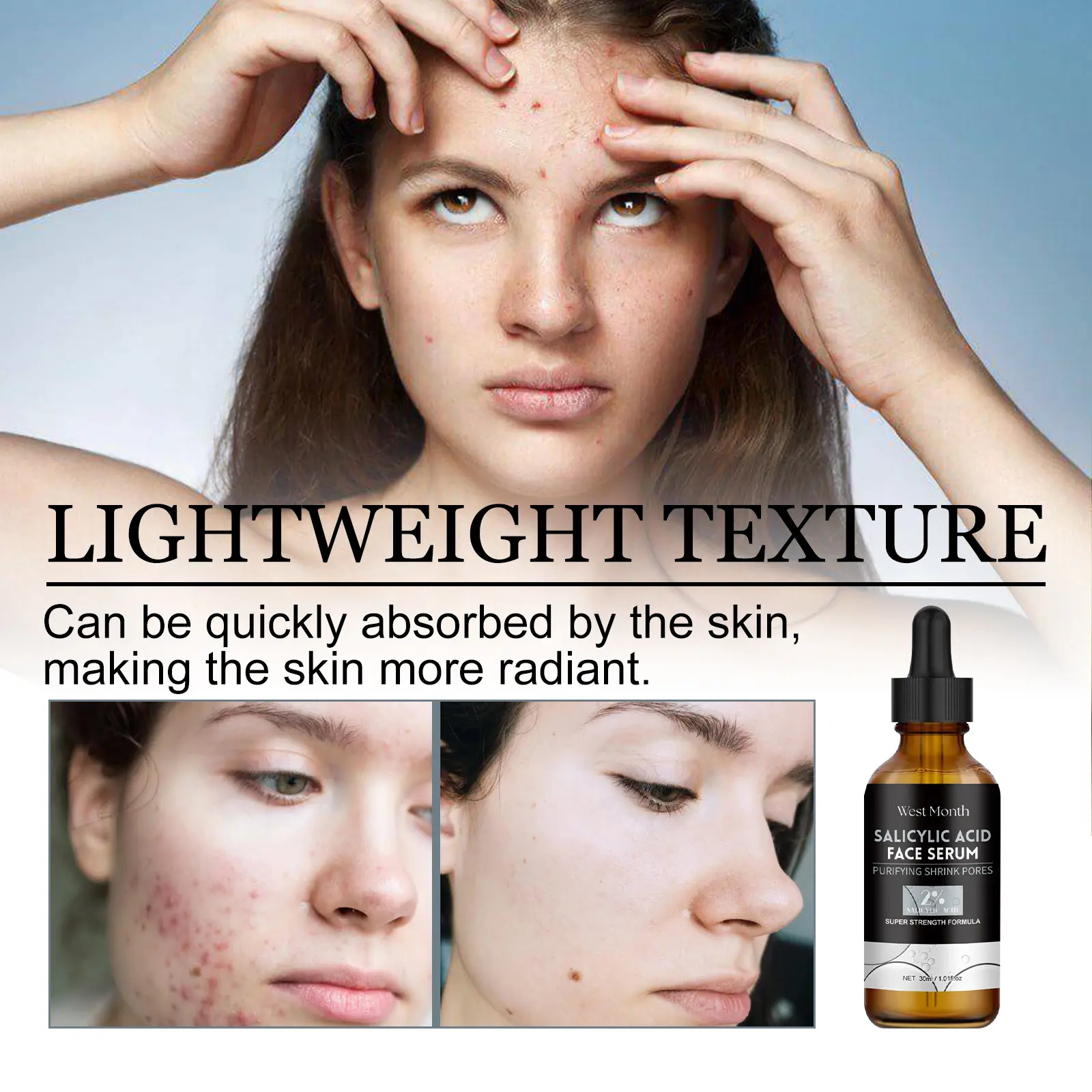 Salicylic Acid Facial Essence for Acne Marks & Hydration - West 8 salicylic acid essence lighten acne mark West Month 278 4608