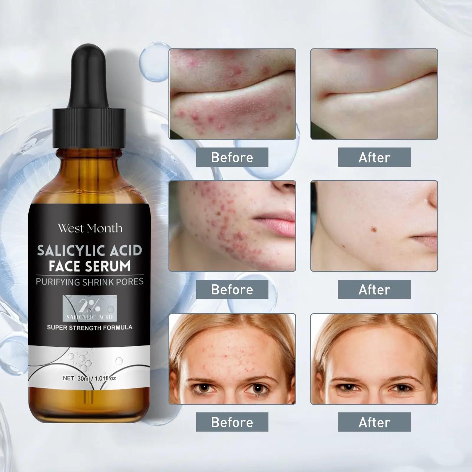 Salicylic Acid Facial Essence for Acne Marks & Hydration - West 9 salicylic acid essence lighten acne mark West Month 278 4609
