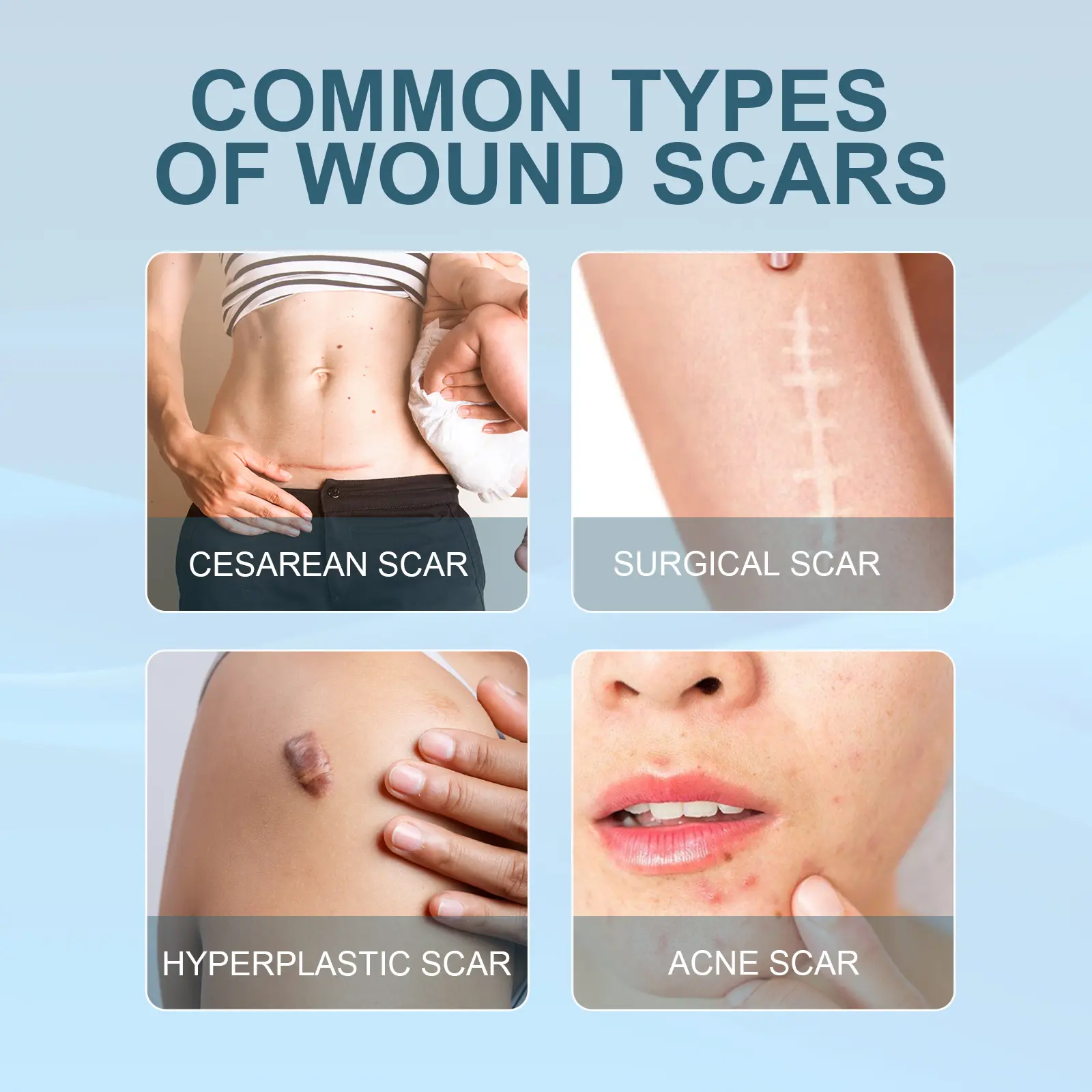 Scar Erase Spray for Fading Scars & Skin Repair - West&Month 6 scar erase spray fade moisturize repair West Month 126 2687