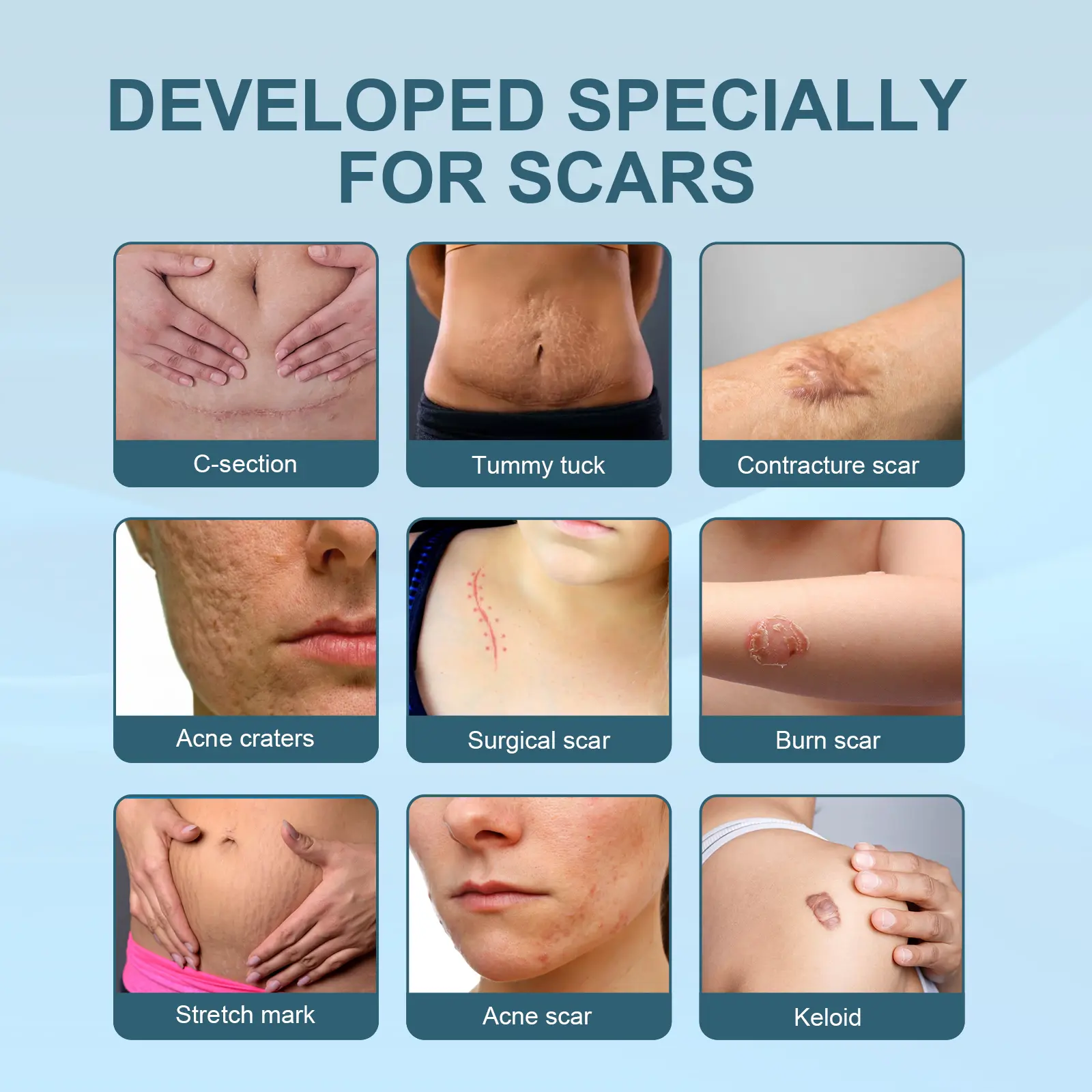 Scar Erase Spray for Fading Scars & Skin Repair - West&Month 8 scar erase spray fade moisturize repair West Month 126 2689