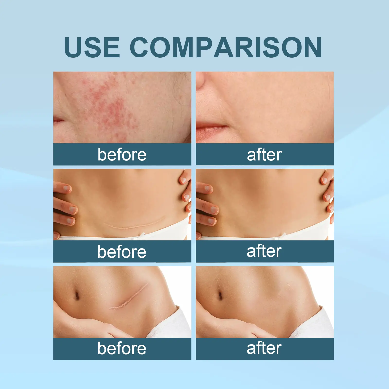 Scar Erase Spray for Fading Scars & Skin Repair - West&Month 9 scar erase spray fade moisturize repair West Month 126 2690