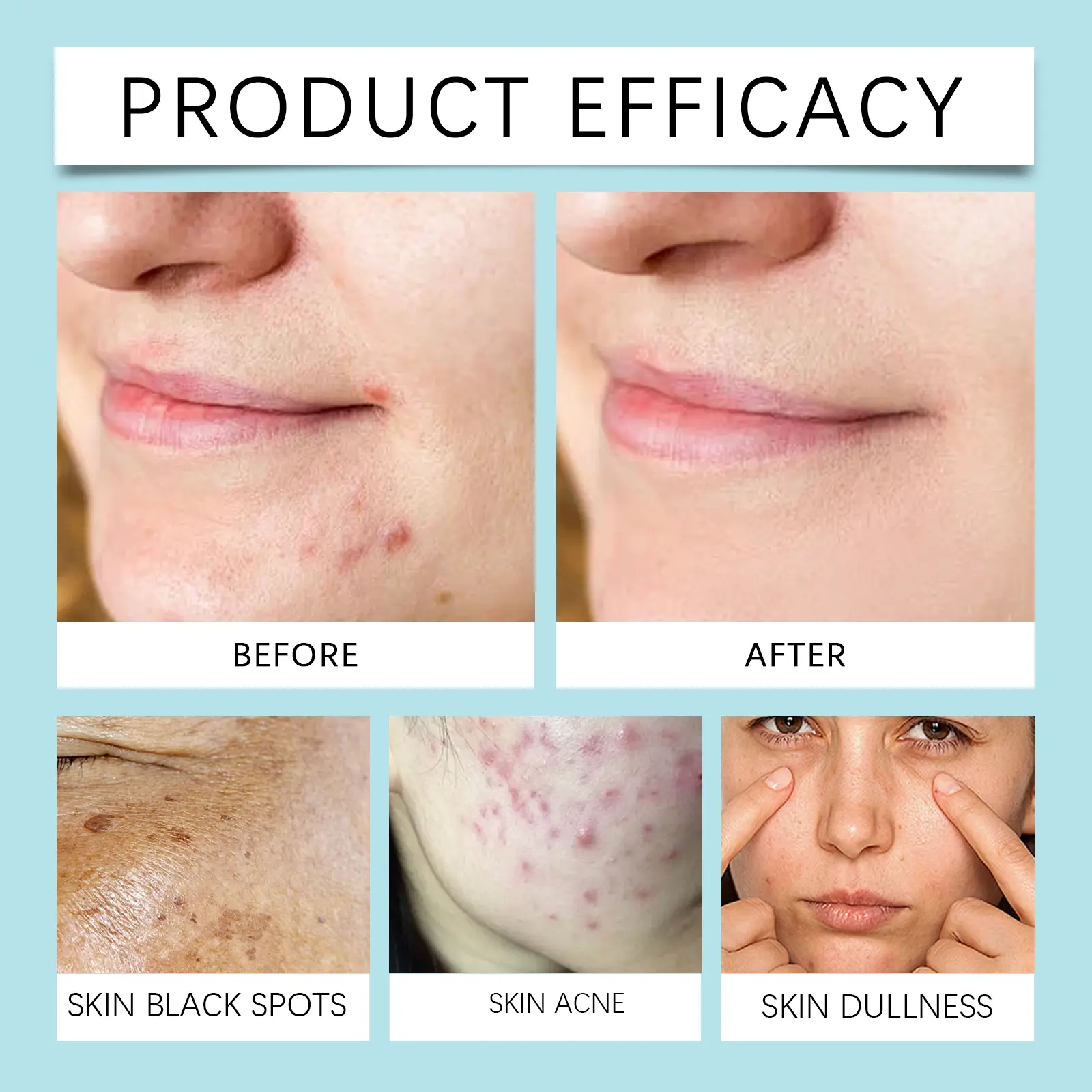 Skin Repair Moisturizer for Acne-Prone Skin with Honey & Collagen - West&Month 9 skin repair moisturizer acne moisturize smooth West Month 498 7632