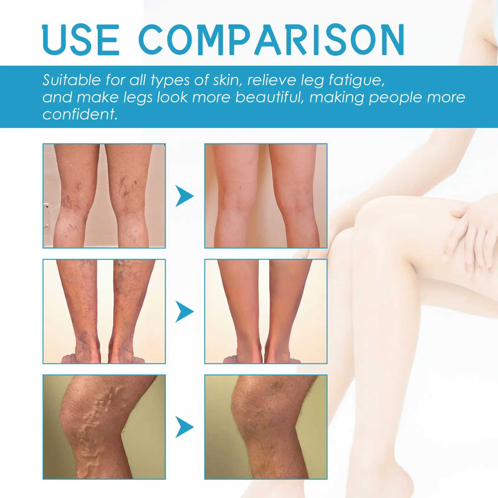 Varicose Vein Cream for Soothing Leg Massage Care - West&Month 7 varicose vein cream relieve pain massage West Month 378 5940