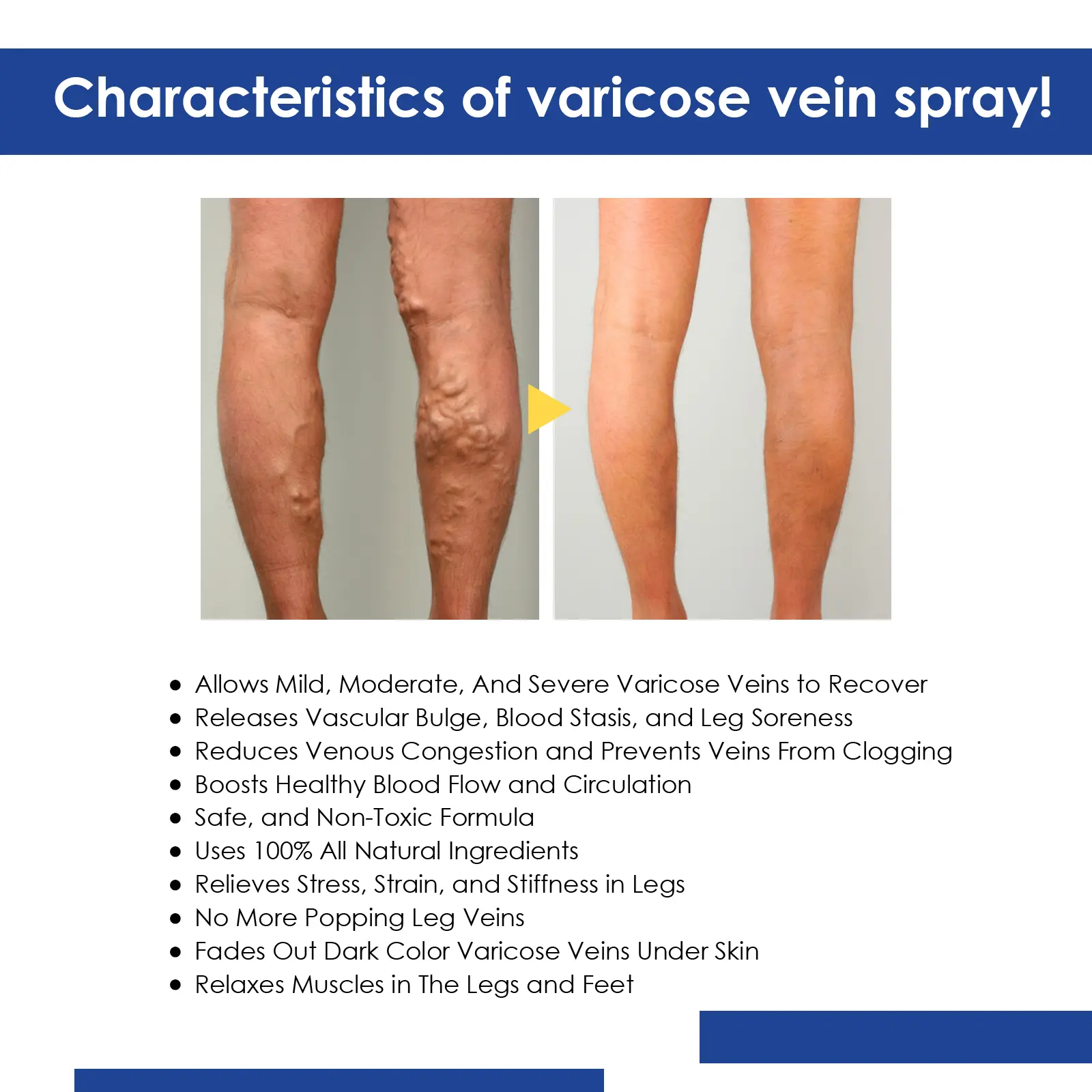 Varicose Vein Support Spray for Leg Wellness and Skin Comfort - West 4 varicose vein spray relieve bulge repair West Month 398 6221