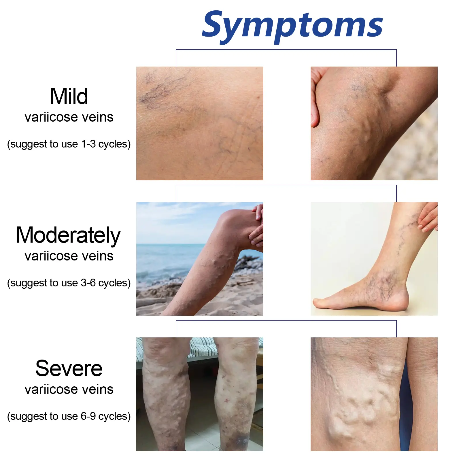 Varicose Vein Support Spray for Leg Wellness and Skin Comfort - West 7 varicose vein spray relieve bulge repair West Month 398 6224