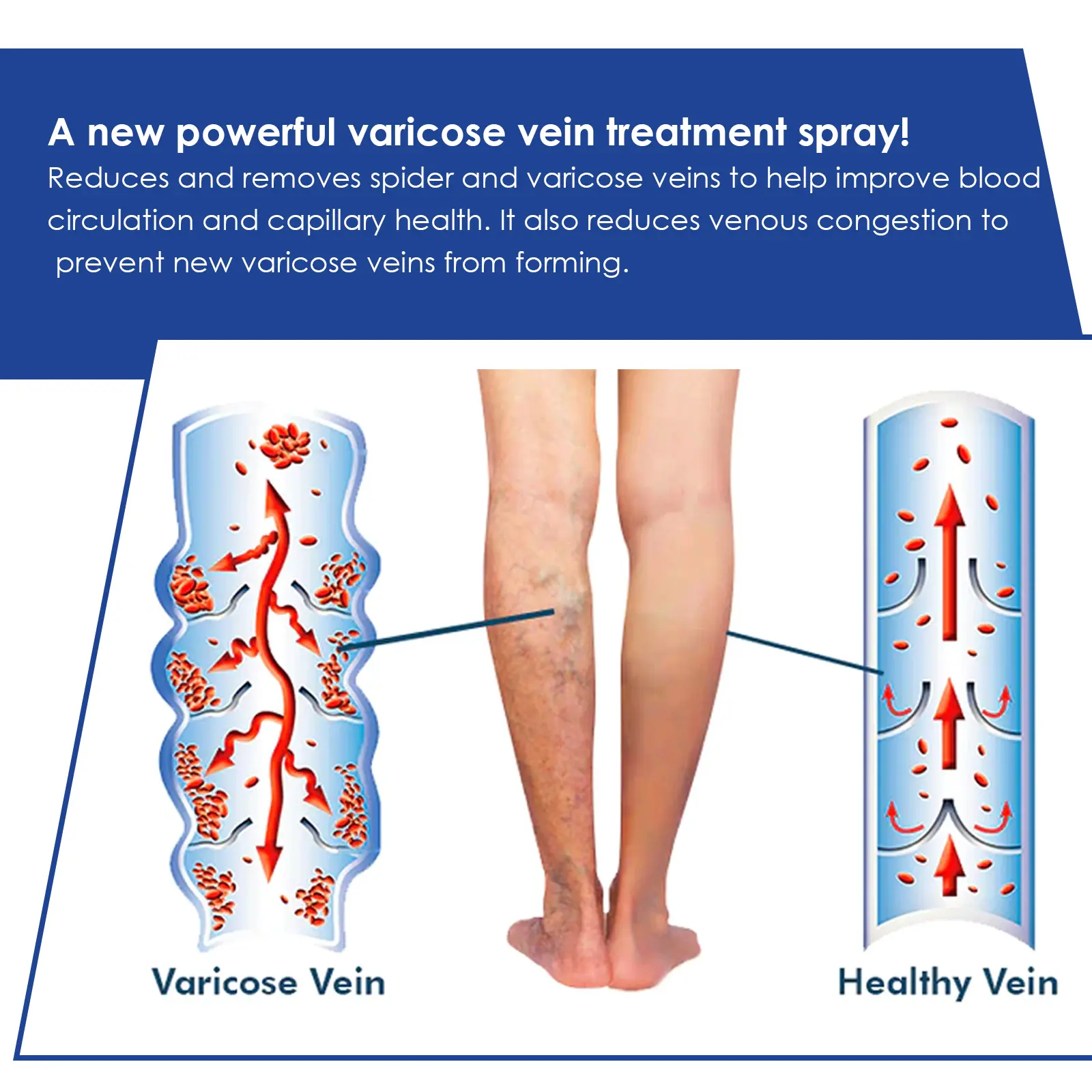 Varicose Vein Support Spray for Leg Wellness and Skin Comfort - West 8 varicose vein spray relieve bulge repair West Month 398 6225