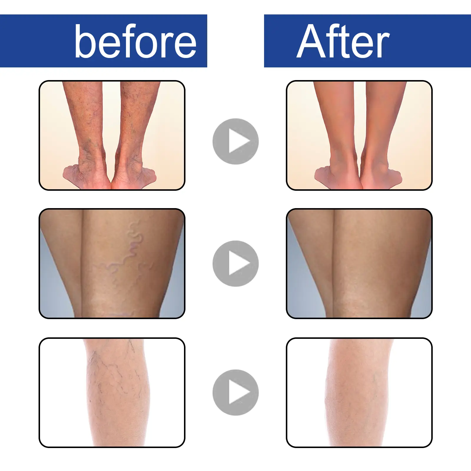 Varicose Vein Support Spray for Leg Wellness and Skin Comfort - West 9 varicose vein spray relieve bulge repair West Month 398 6226