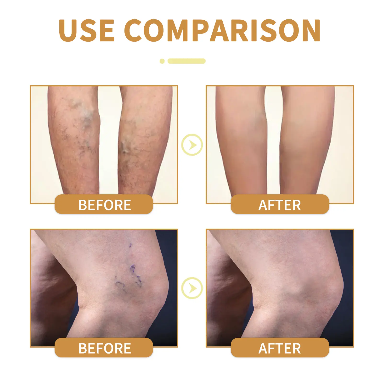 Vitamin K Varicose Vein Cream for Soothing Leg Relief - West&Month 9 vitamin k varicose vein cream West Month 186 3450